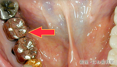 健康保険の全部被せ物