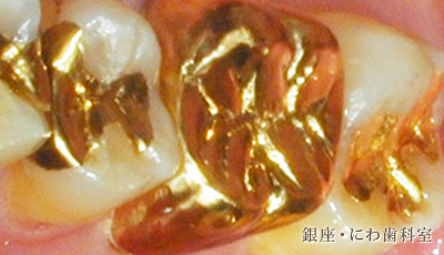 自由診療の全部被せ物