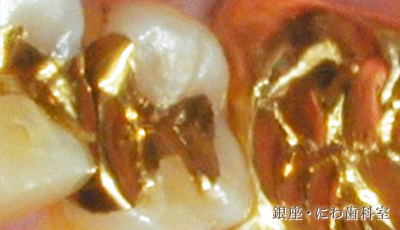 自由診療の部分被せ物